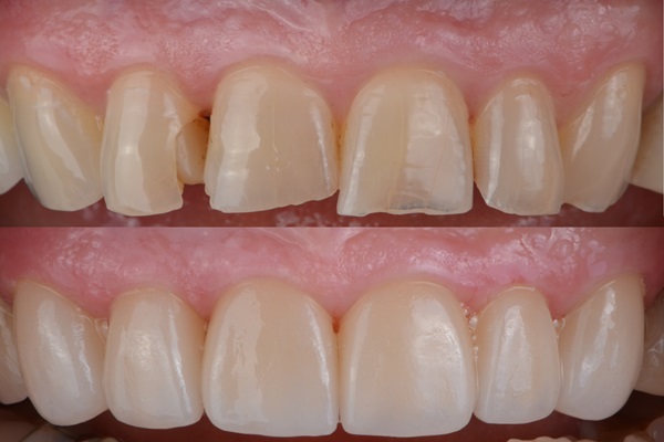 Lumineers® For Gaps Between Teeth