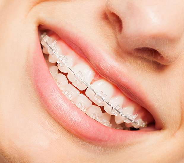 Huntsville Invisible Orthodontics