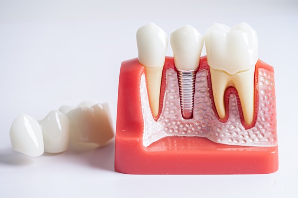 How A Tooth Is Prepared To Have A Dental Crown Restoration