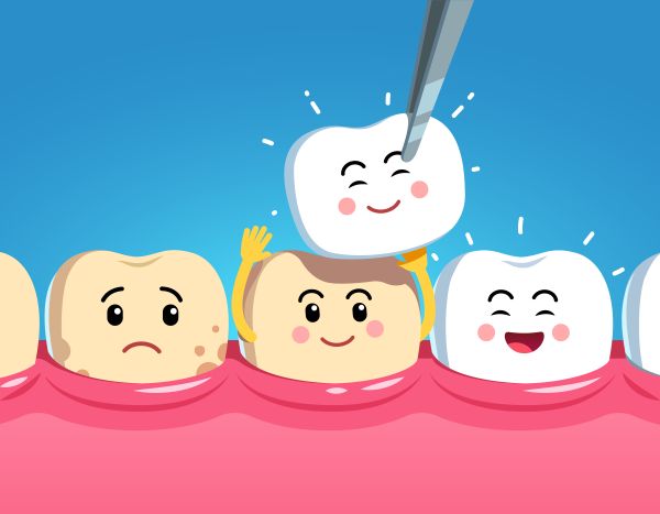 Should I Get Dental Crowns Or Veneers?