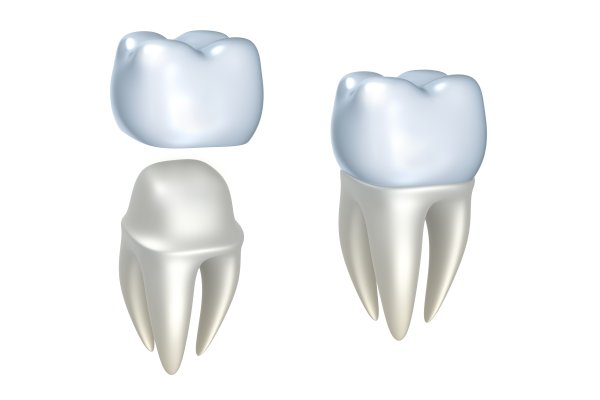 What To Do With A Loose Dental Crown