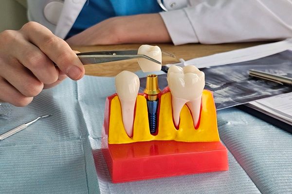 Is Tooth Extraction Necessary Before Receiving Dental Implants?