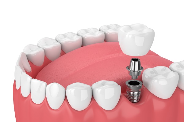 When Would A Family Dentist Recommend Dental Implants?