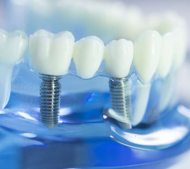Huntsville Dental Implants
