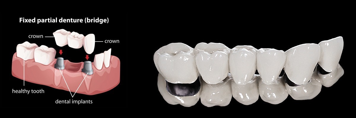 Huntsville Dentures