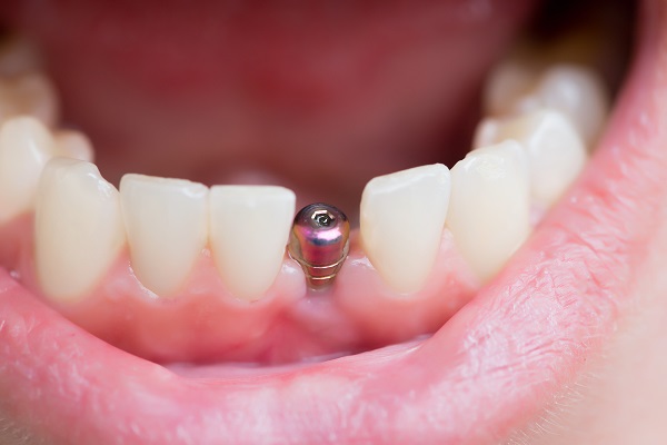 Implant Dentist Huntsville, AL