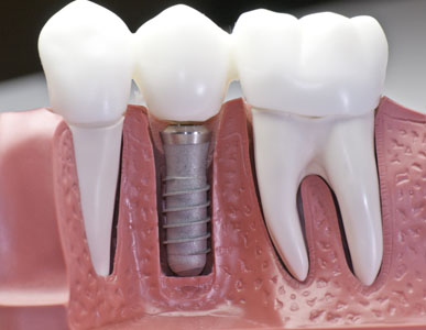 Learn How An Implant Restoration Can Help You