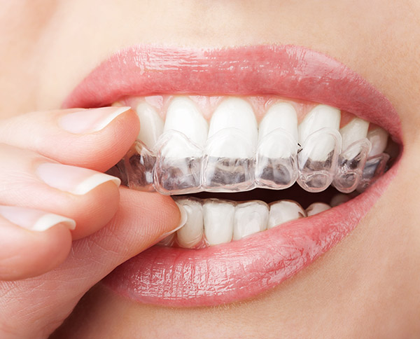 Things To Know Before Getting Invisalign