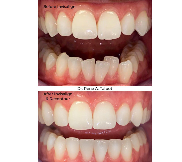 Huntsville Invisalign Dentist
