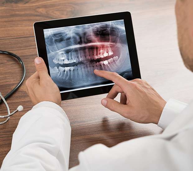 Huntsville Types of Dental Root Fractures